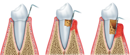 PERIODONCIA