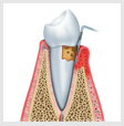 Periodoncia