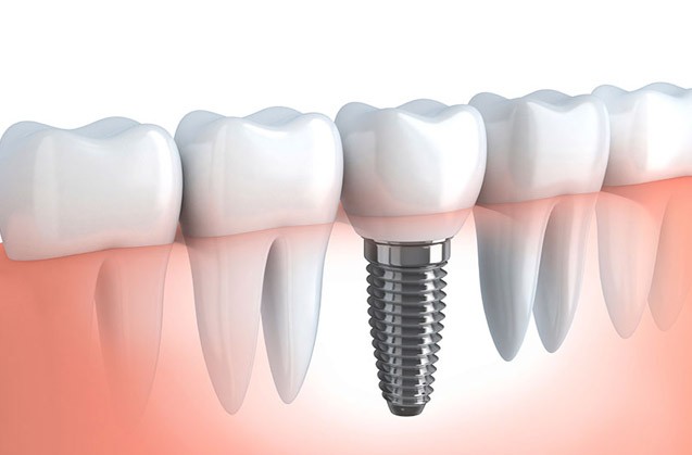 El correcto cuidado de los implantes