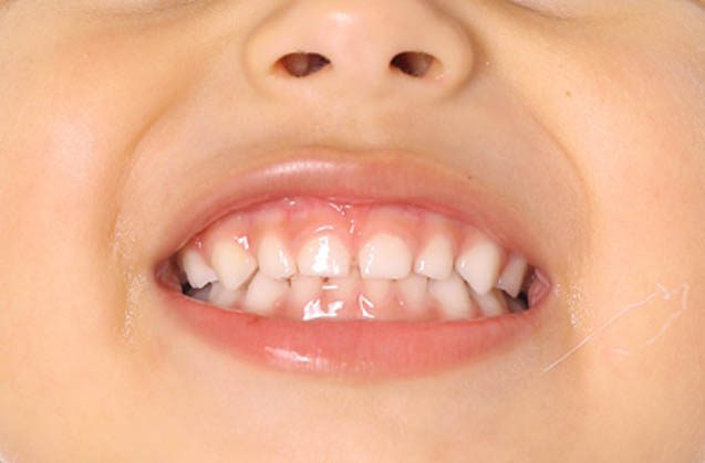 ¿Por qué le rechinan los dientes a mi hijo?