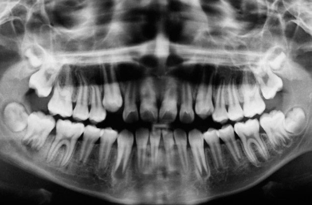 Usos de las radiografías dentales en consulta