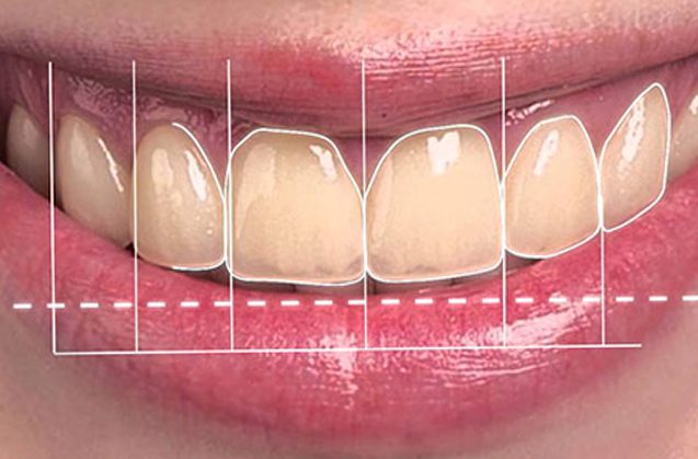 Sonrisa Invisalign