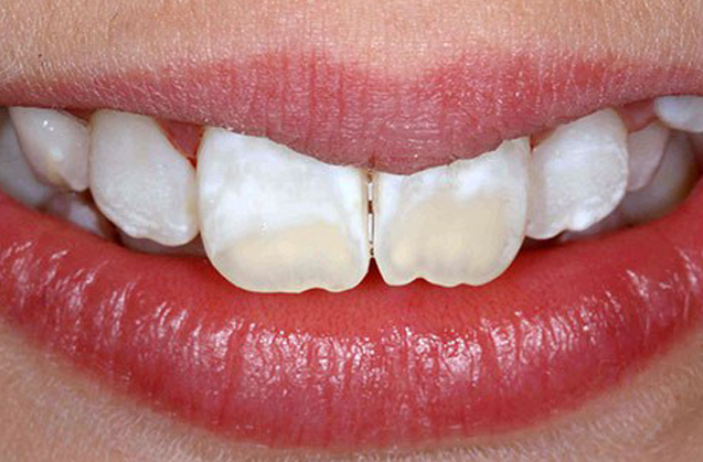 Manchas en los dientes: ¿por qué aparecen y cómo eliminarlas?