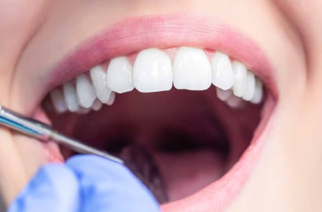 ¿Cada cuánto es necesaria una limpieza dental profesional?