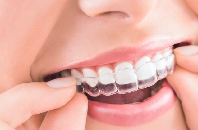 Invisalign y consigue tu mejor sonrisa