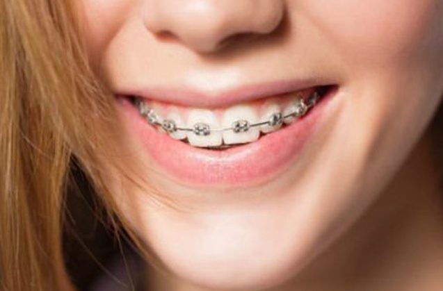 ¿Qué tipos de brackets existen y cuáles son sus diferencias?