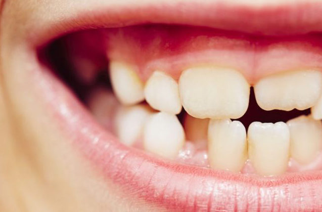 Apiñamiento dental: ¿Porqué se produce?