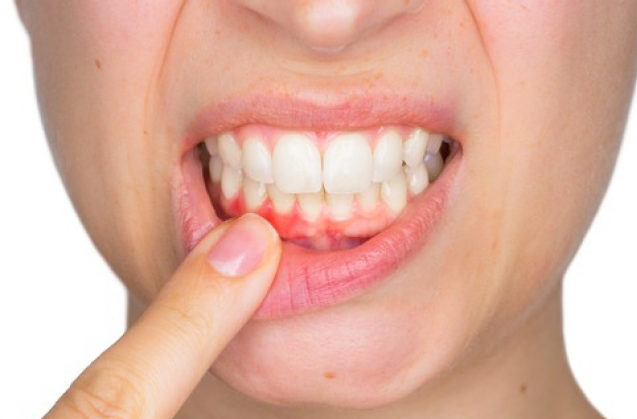 Gingivitis y su tratamiento