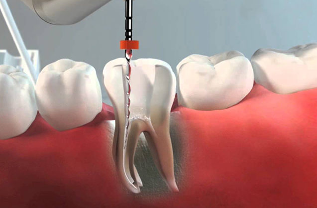 Cuándo realizar una endodoncia