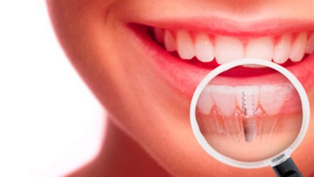 ¿Qué problemas causan los implantes dentales?