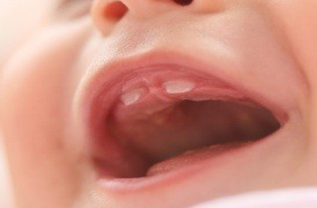 ¿Problemas dentales en bebés?