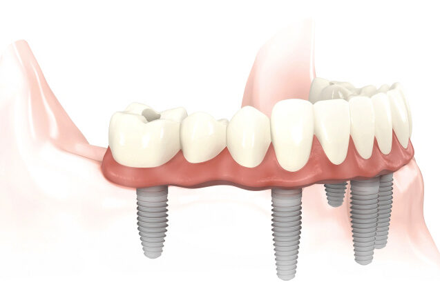 Ventajas de la rehabilitación con implantes