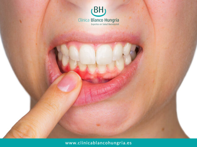 ¿Cómo prevenir la periodontitis?