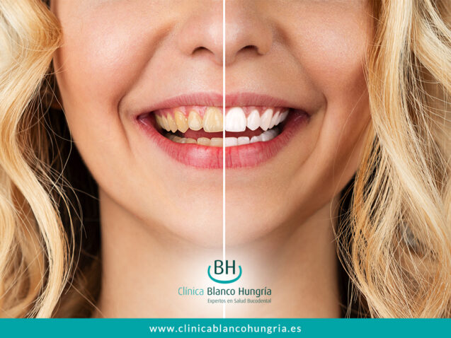 Manchas en tus dientes: Causas y Soluciones